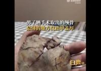 男子術后曬顱骨碎片:最薄處像指甲