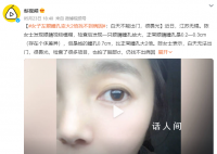 女子左眼瞳孔變大2倍找不到病因 白天無法出門很畏光