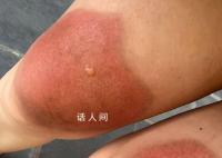 女子云南穿破洞褲7小時腿被曬傷 經醫生診斷為二級燙傷