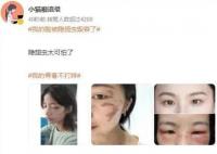 我的臉被隱翅蟲毀容了 不少網友曬出同款傷疤