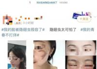 隱翅蟲的毒液堪比硫酸 隱翅蟲是什么來頭?