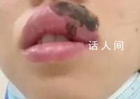 女子睡覺被蜈蚣咬醒 嘴腫成“香腸”