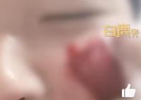 男生擠痘流血近1小時:用了400張紙