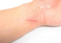 9歲女孩被貓抓傷高燒14天 四肢冰涼且頭痛精神不佳