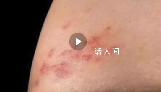 新冠后得帶狀皰疹的人變多了?將帶狀皰疹納入診斷體系