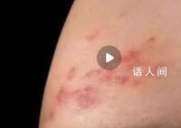 新冠后得帶狀皰疹的人變多了?將帶狀皰疹納入診斷體系
