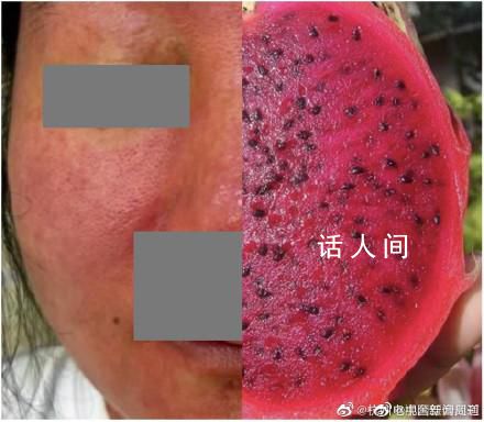 杭州女子養倉鼠臉爛成火龍果 整張臉紅得發紫