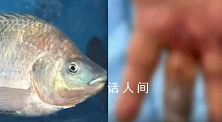 男子被魚刺刺傷致手指壞死被截除 目前該男子身體狀況已經好轉