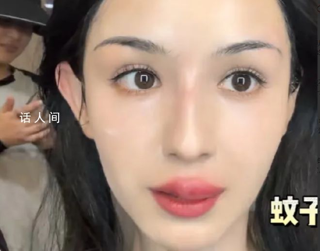 哈妮克孜被蚊子咬成香腸嘴 這一意外引起了廣大網(wǎng)友的共鳴和關(guān)注