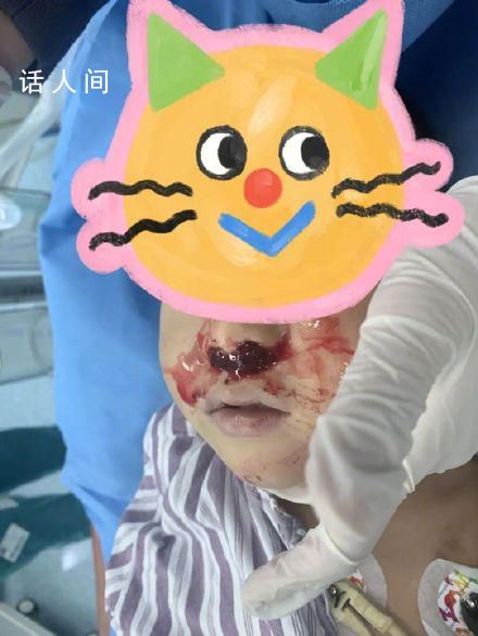 奶奶向3歲男童鼻腔塞頭發(fā)止血 送到醫(yī)院的時(shí)候已經(jīng)出現(xiàn)休克現(xiàn)象