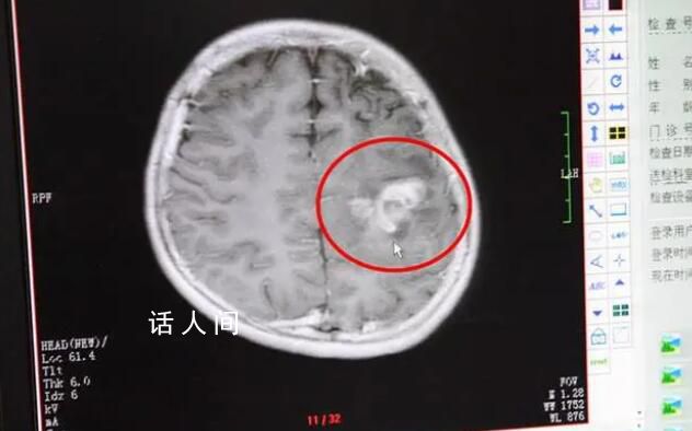 醫(yī)生7小時(shí)取出小伙腦內(nèi)10cm成蟲(chóng) 目前患者已經(jīng)可以下床行走