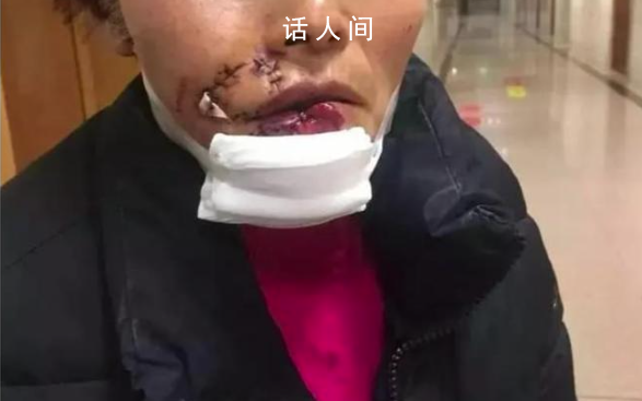 女子被狗撕碎左臉縫了500多針 實在是太可怕了