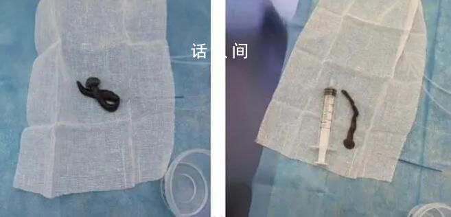 女子咳嗽半月 氣管發現8cm螞蟥