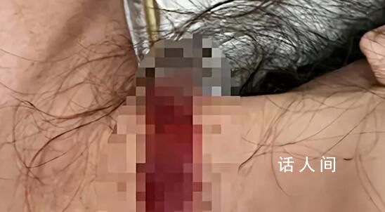 女子稱孕期遭家暴被丈夫拿刀割脖子 婦聯(lián)表示已介入調(diào)查