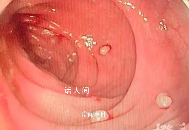 14歲男孩腸道里查出20多顆“珍珠” 爸爸爺爺均因此去世