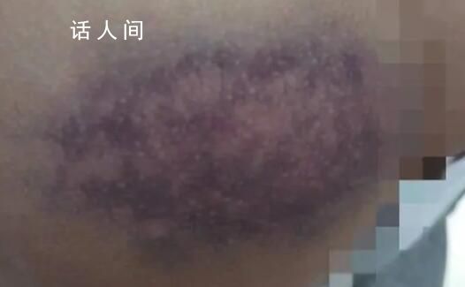 官方調查學生屁股被老師打成黑紫色 引發家長的不滿