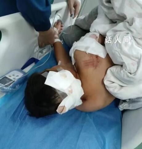 咬傷10歲男童的阿拉斯加犬已被打死 男童仍在湖南省兒童醫院ICU病房內搶救