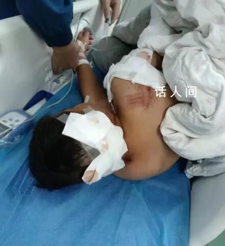 男童遭阿拉斯加犬咬傷 仍在ICU救治