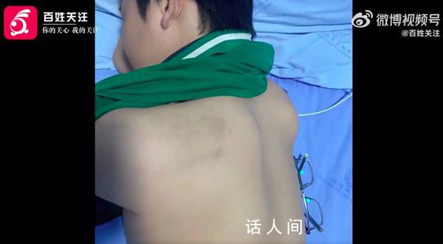 家長稱13歲兒子被紀律委員打骨折 身體多處軟組織損傷