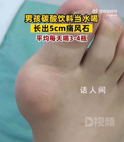 男孩1天4瓶飲料長5厘米痛風石  腳趾關(guān)節(jié)處已經(jīng)堆積大量的痛風石