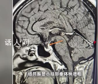 男子每天喝30斤水去50次廁所 連喝茶都是用盆來接