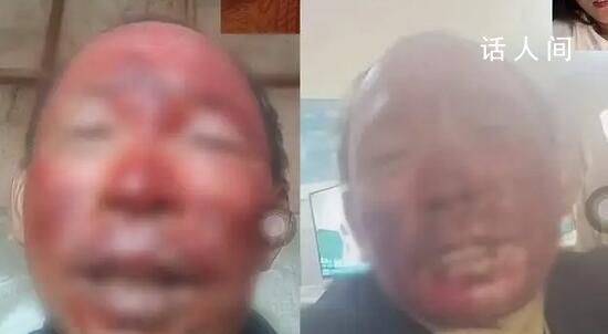 女婿去世女兒住院 男子燒傷不舍就醫
