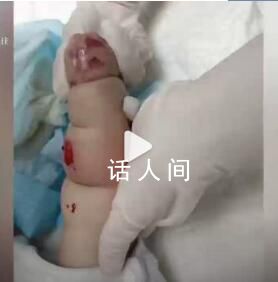 嬰兒遇輸液滲水起大片紅腫水泡 愿小寶寶能盡快痊愈