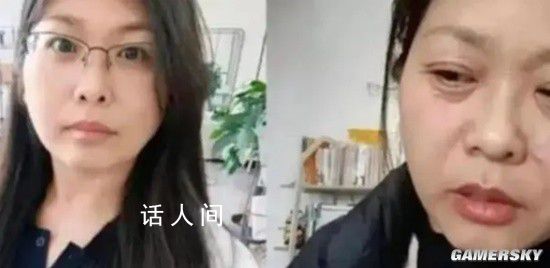 42歲斷崖式衰老女子確診卵巢早衰 臉部皺紋明顯眼神憔悴