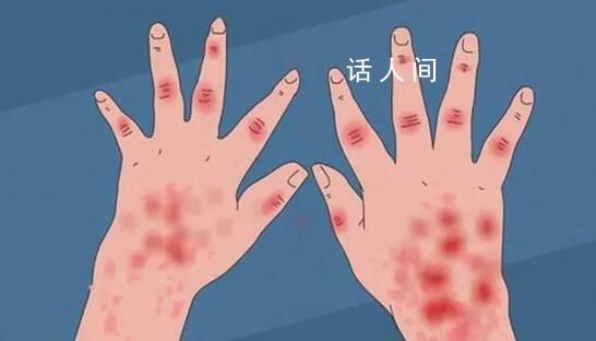 21歲男子發(fā)燒后被診斷為紅斑狼瘡 女性發(fā)病率是男性的十倍