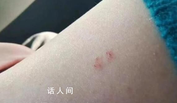 女子花2500住酒店被蛇咬 雙方已和解