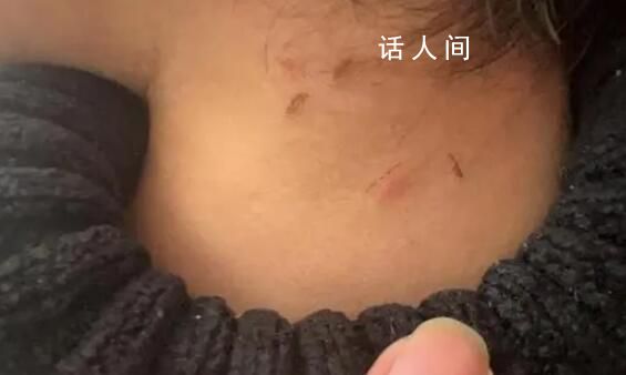 家長稱孩子遭老師虐待 身上都是摳痕
