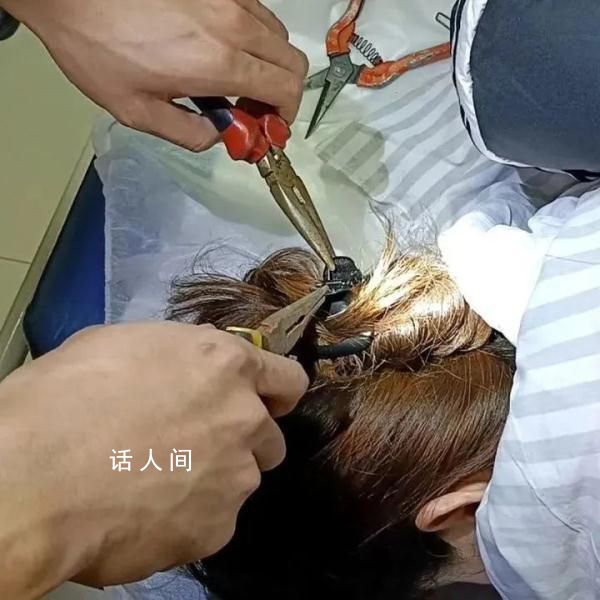女子出車禍鯊魚夾插入后腦勺 必須盡快將夾子取下才能做進(jìn)一步治療