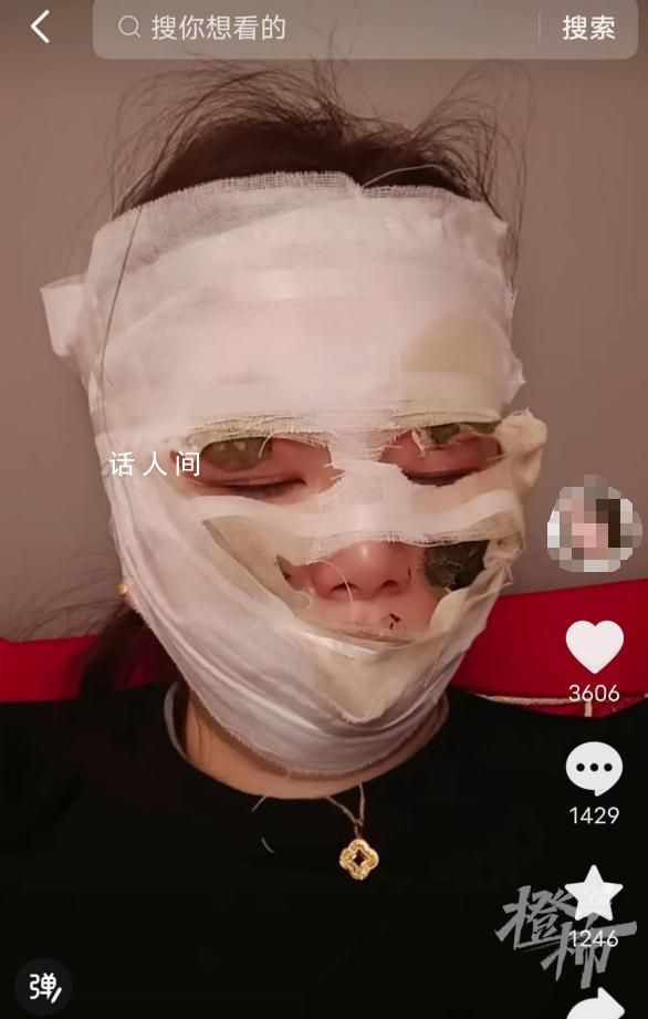 新娘結婚當天被噴霧彩帶燙傷 整張臉都被纏滿繃帶