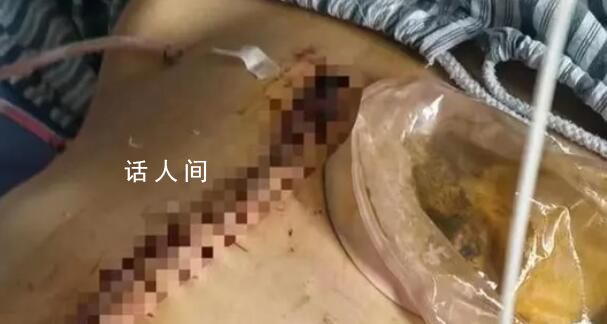 女子被家暴16次需終身掛糞袋案進展 當(dāng)事人回應(yīng)