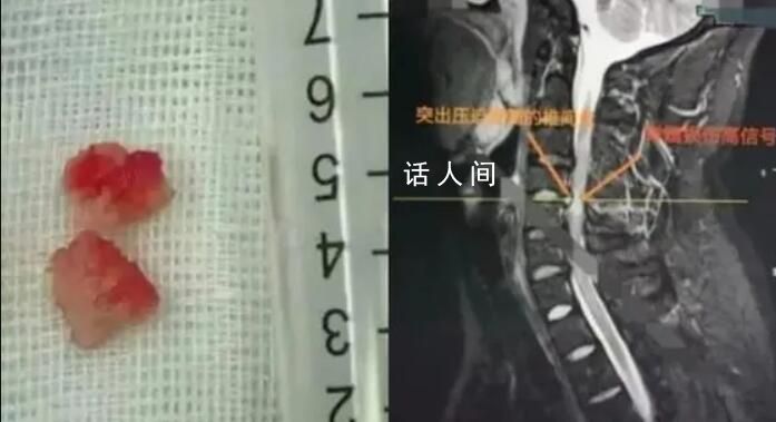 男子在私人工作室按摩險(xiǎn)全身癱瘓 兩塊椎間盤組織掉入椎管中