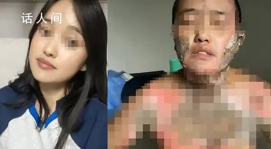 官方通報女子被丈夫潑酒點火燒傷 已組建聯合工作組主動介入