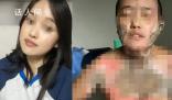 官方通報女子被丈夫潑酒點火燒傷 已組建聯合工作組主動介入