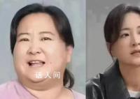 醫(yī)生稱賈玲式減肥要有診療團(tuán)隊(duì) 即便做減重手術(shù)也很難達(dá)到這個(gè)效果