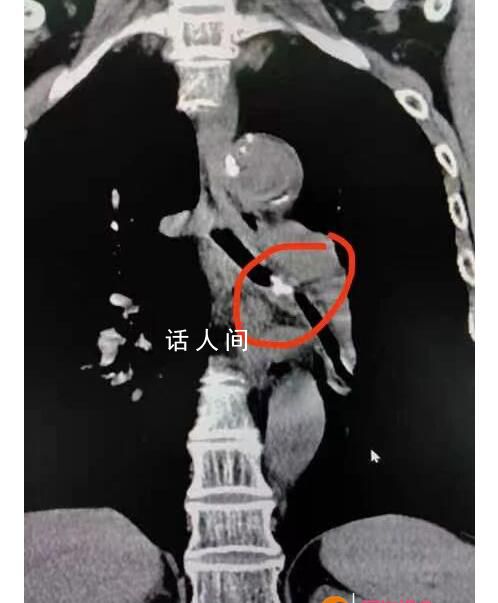 女子咳嗽20年竟因雞骨頭卡氣管 將左支氣管完全堵塞