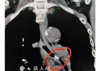 女子咳嗽20年竟因雞骨頭卡氣管 將左支氣管完全堵塞
