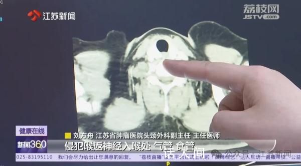 一家三口同患上甲狀腺癌 哪些篩查不能忽視