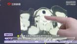 一家三口同患上甲狀腺癌 哪些篩查不能忽視