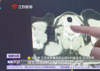 一家三口同患上甲狀腺癌 哪些篩查不能忽視