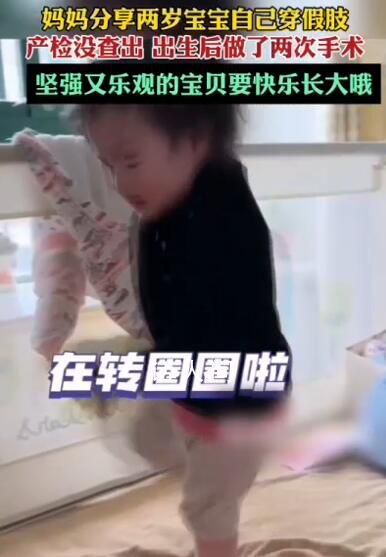 2歲寶寶已穿1年小腿假肢 網友：堅強又樂觀的寶貝要快樂長大