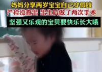 2歲寶寶已穿1年小腿假肢 網(wǎng)友：堅(jiān)強(qiáng)又樂(lè)觀的寶貝要快樂(lè)長(zhǎng)大