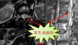 男子吞蛇膽喝蛇藥15年后發病 生吃蛇染寄生蟲