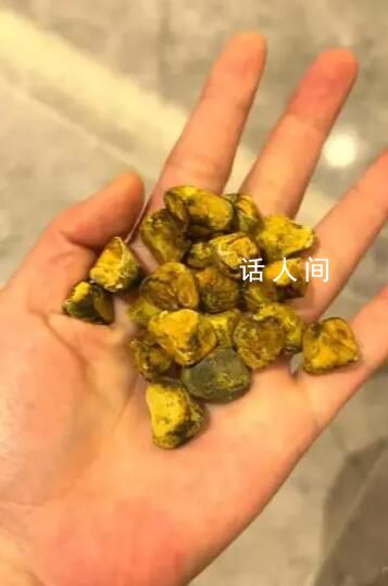 女生取24顆膽結石沒事盤著玩 21顆膽結石留在了手中