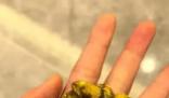 女生取24顆膽結(jié)石沒事盤著玩 21顆膽結(jié)石留在了手中