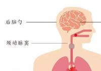 衣領綜合征是什么梗 衣領綜合征是什么意思
